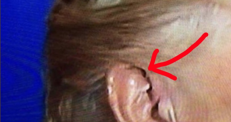 PHOTO Donald Trump Was Wearing A Chip In His Ear During Debate