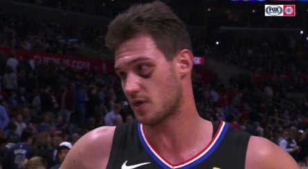 PHOTO Danilo Gallinari Looking Like Extra In Rocky With Massive Black Eye