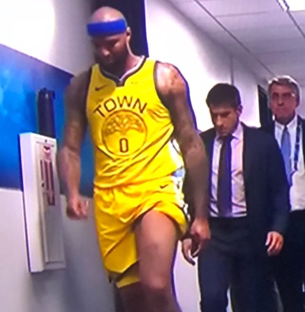 PHOTO Demarcus Cousins Quad Is SWOLLEN