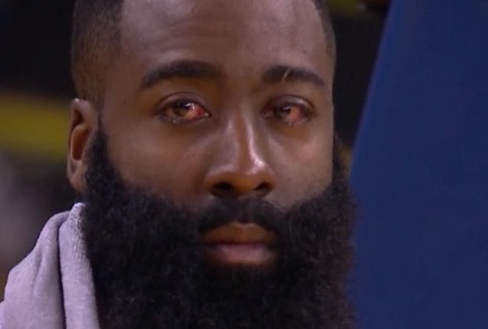 PHOTO James Harden's Left Eye Is Swollen