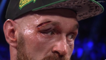 PHOTO Tyson Fury's Cut Over His Eye