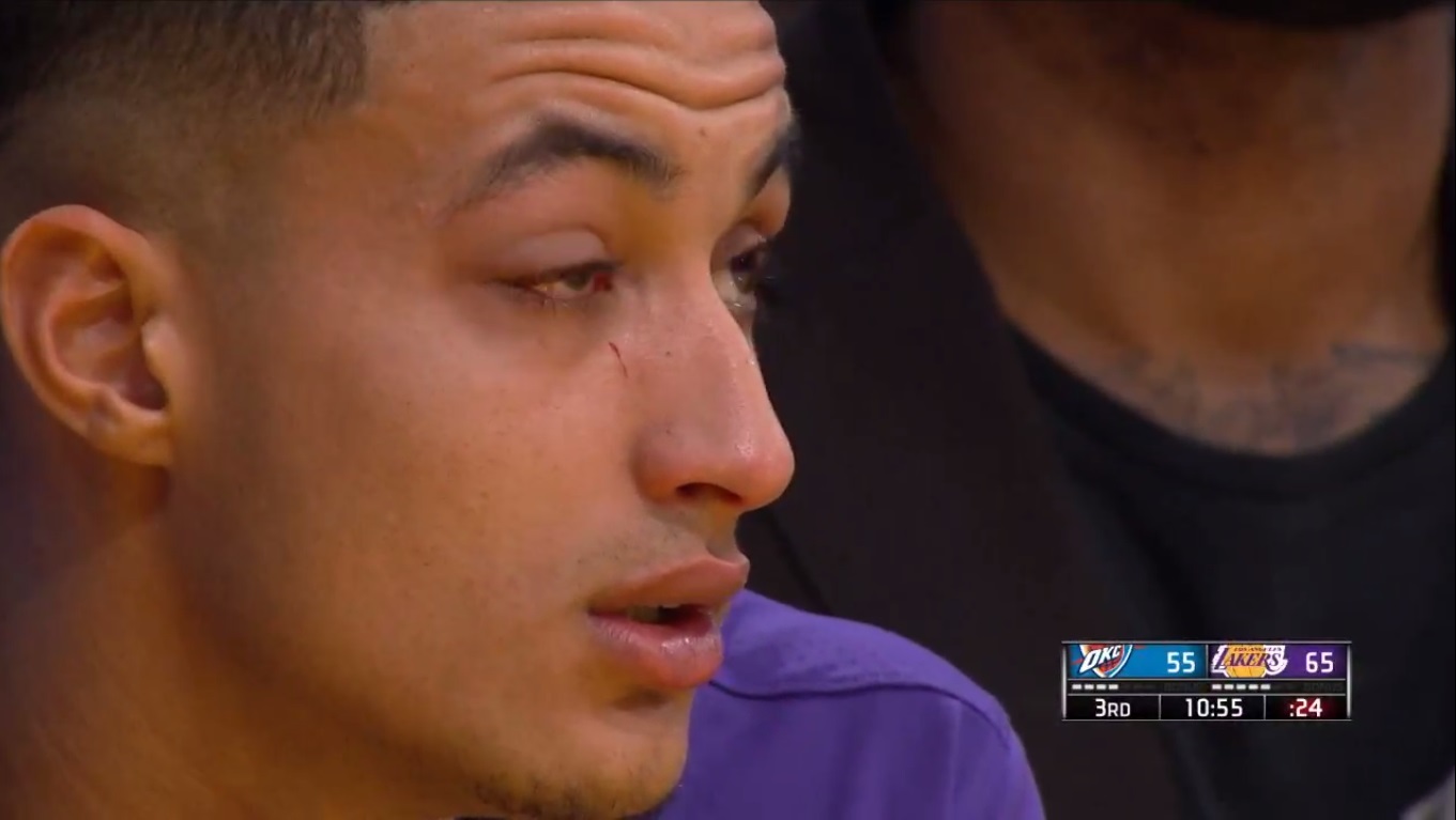 Close Up HD PHOTO Kyle Kuzma's Eye Is Swollen As Hell