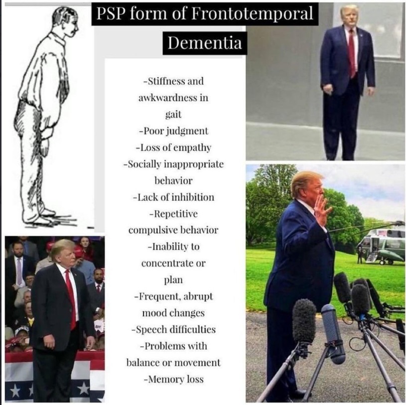 PHOTO Donald Trump Has All The Signs Of PSP Form Of Frontotemporal Dementia