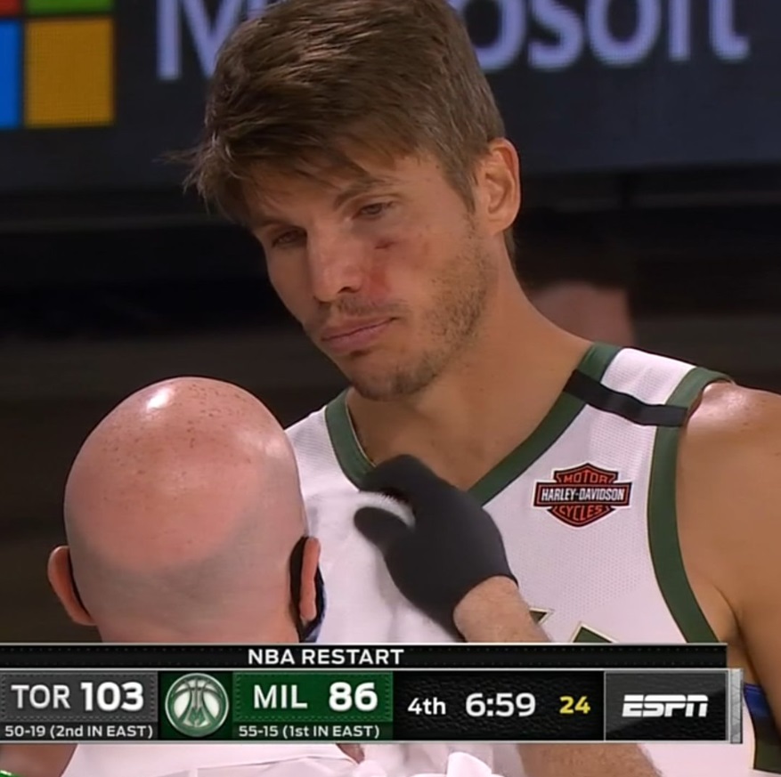 PHOTO Kyle Korver Cut Under His Eye From Game Monday