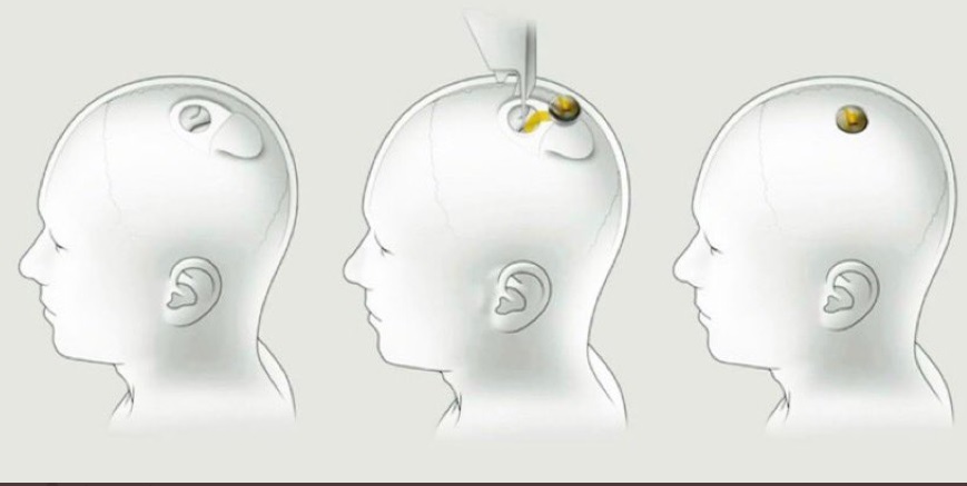 PHOTO What Neura Link Looks Like Implanted In The Brain