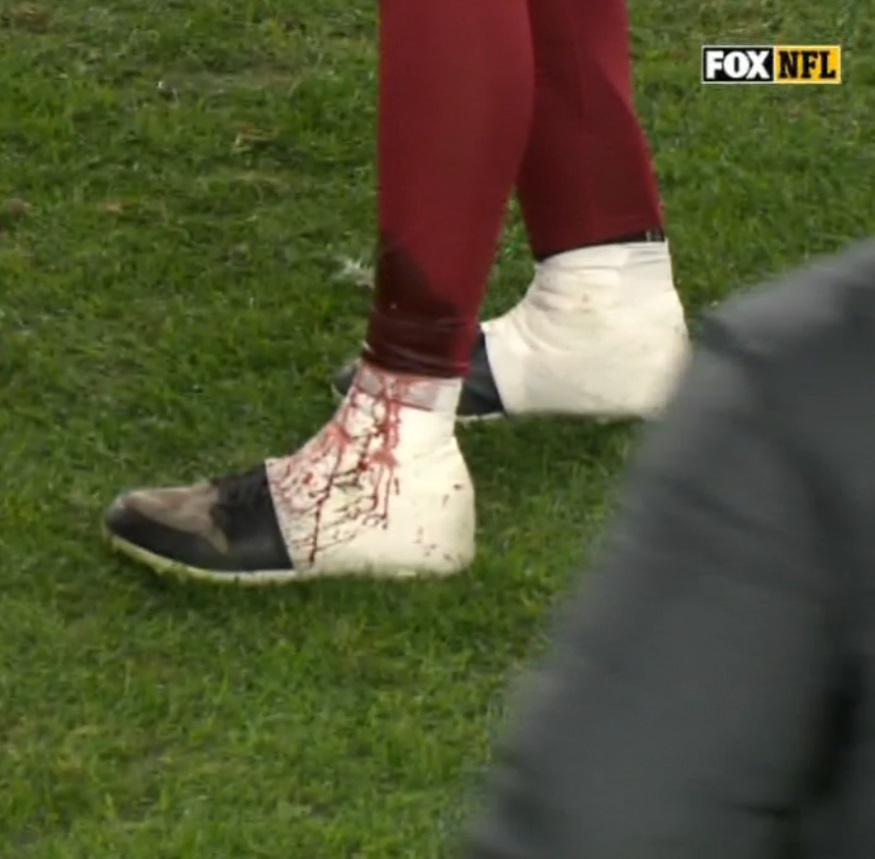 PHOTO Alex Smith Bleeding From His Ankle