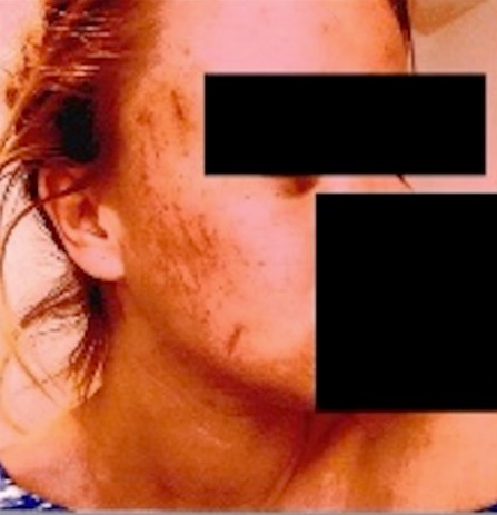 PHOTO Of Cuts And Bruises On Trevor Bauer's Accusers Face