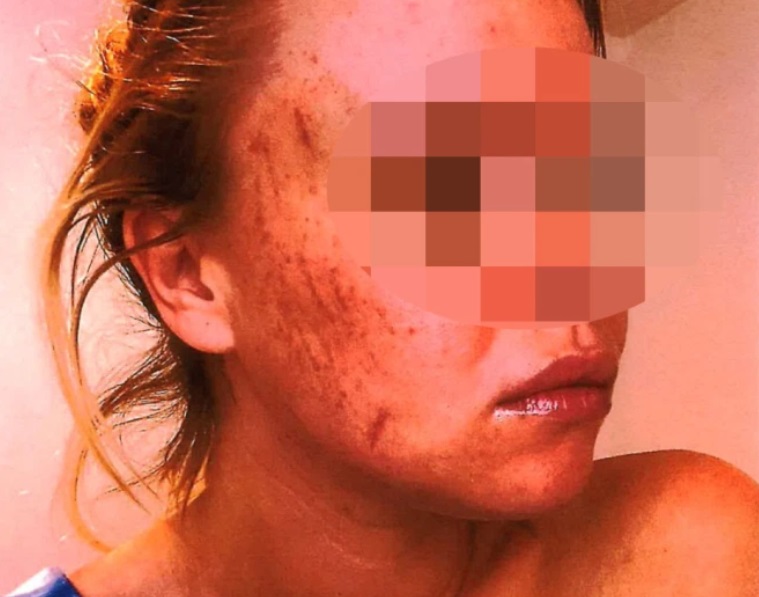 PHOTO The Scratches On Trevor Bauer's Accusers Face Are So Large It's Jarring What Bauer Did