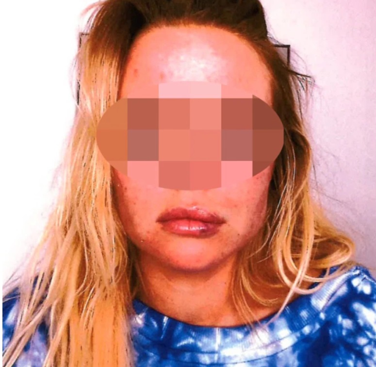 PHOTO Trevor Bauer's Accuser With Two Black Eyes And A Bloody Lip