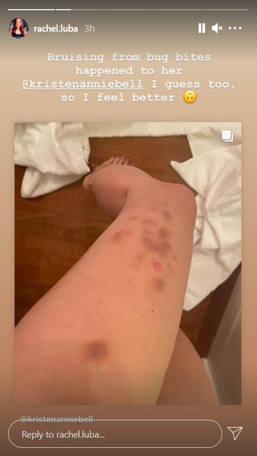 PHOTO Trevor Bauer's Girlfriend Has Bruising On Her Leg