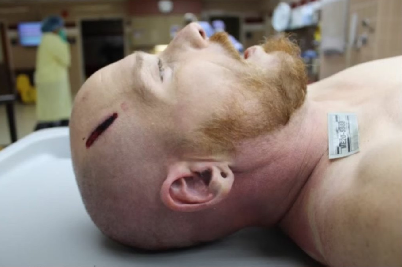 PHOTO Close Up Of Joseph Rosenbaum's Head In The ICU Had Massive Bloody Mark After Kyle Rittenhouse Shot Him