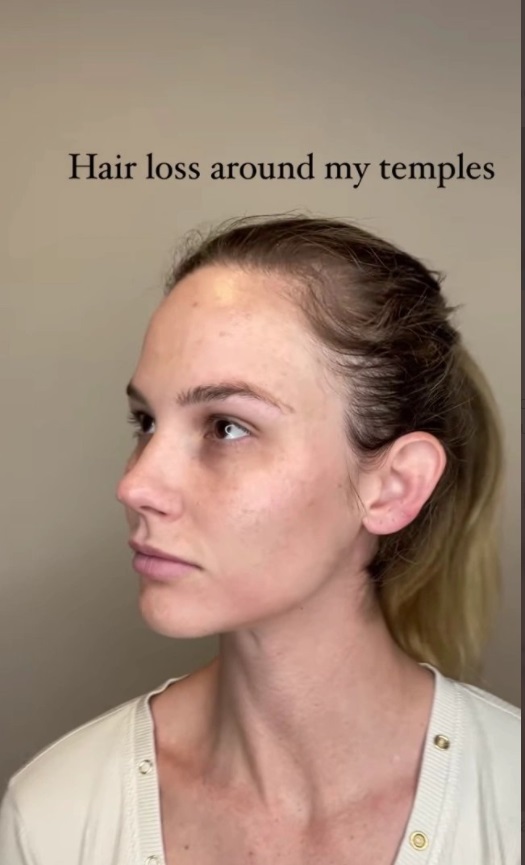 PHOTO Meghan King Showing Proof Of Hair Loss After Divorce