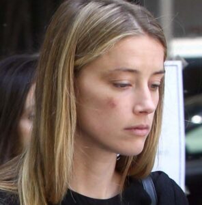 PHOTO Amber Heard Planted A Fake Bruise On Her Face On May 27th 2016 And It Was Gone The Very Next Day
