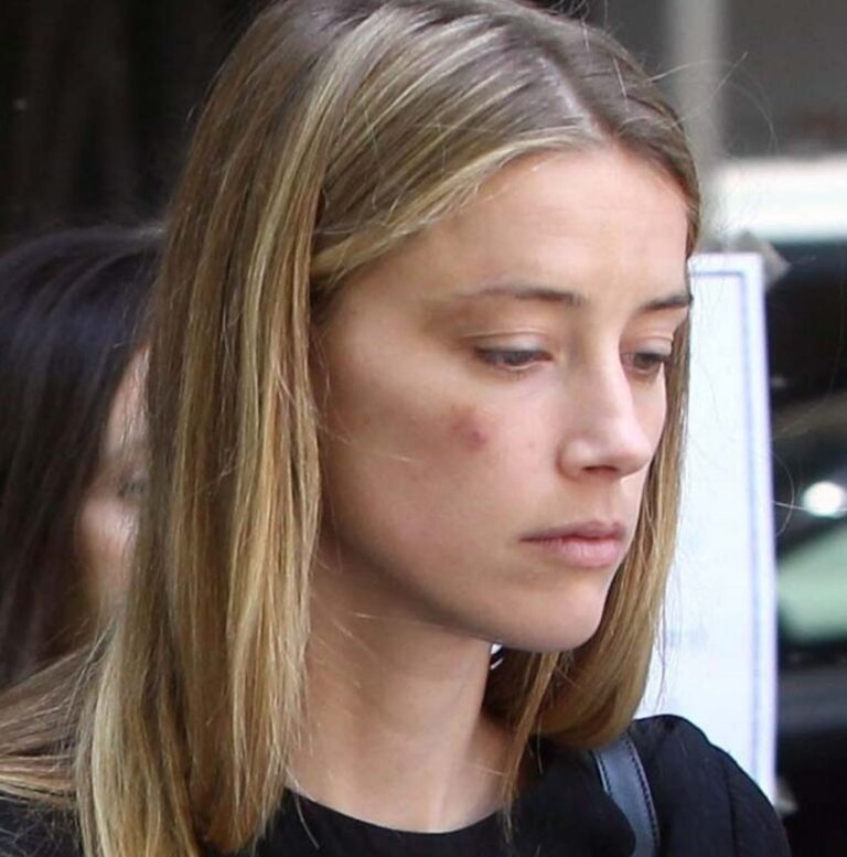 PHOTO Amber Heard Planted A Fake Bruise On Her Face On May 27th 2016 ...