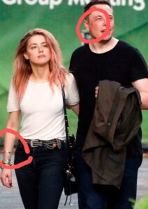 PHOTO Close Up Of Amber Heard's Bruise On Her Arm And Elon Musk's Swollen And Bruised Face Raises A Lot Of Questions On What Happened