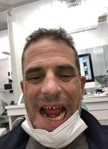 PHOTO Hunter Biden Is Missing All Kinds Of Teeth Because Of His Heavy Drug Use