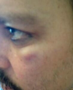 PHOTO Of Bruise Below Johnny Depp's Left Eye After Amber Hit Him