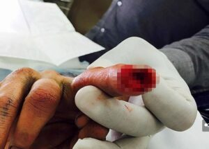 PHOTO Of Doctor Showing Johnny Depps Finger Missing A Piece And Bleeding Before Surgery