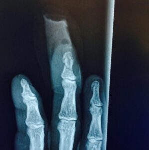 PHOTO X-Ray Of Johnny Depp's Chopped Off Finger