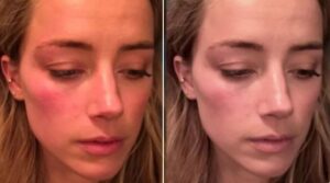 PHOTO Amber Heard Genuinely Thought She Could Get Away With Saying Two Pictures Of Alleged Injuries On Her Were Different When It Was Just Makeup