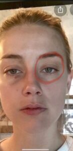 PHOTO Amber Heard Had No Broken Blood Vessels In The Eyes Despite Making It Look Like She Got Hit In The Face By Johnny Depp
