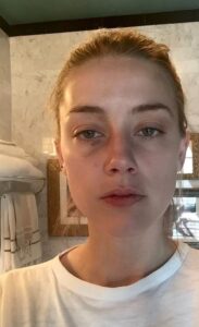 PHOTO Amber Heard Used Botox To Make Her Face Look Like She Had A Broken Nose Little Marks Under Her Eye Are From Injections That Cause Eye Marks