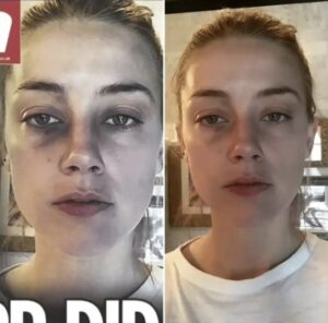 PHOTO Amber Heard's Fake Injuries Look More Like She Doesn't Sleep Than Got Hit In The Face