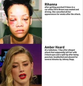 PHOTO Even If Amber Heard Could Magically Hide All The Bruising She Absolutely Can't Hide Swelling With Makeup