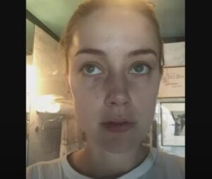 PHOTO Example Of Filler Bruising From Botox Injection That Amber Heard Did To Make Fake Injuries On Her Face