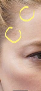 PHOTO Of Abuse Marks On Amber Heard's Head That Could Be Seen In Court On Thursday