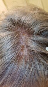 PHOTO Of Amber Heard's Scalp Showing Missing Hair From When Johnny Pulled Large Chunks From Her Head