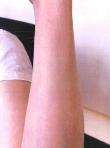 PHOTO The ONLY Evidence Amber Heard Has From Australia Is A 2 Foot Long Human Nail Scratch On Her Arm