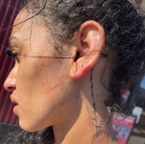 PHOTO Of Miles Bridges' Wife At Hospital With Brusing And Bleeding All Over Her Face After Miles Got Charged With Domestic Violence