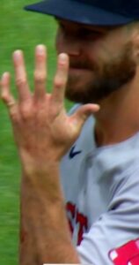 PHOTO Super Close Up Of Chris Sale's Pinkie Broken Right In The Middle Of The Finger