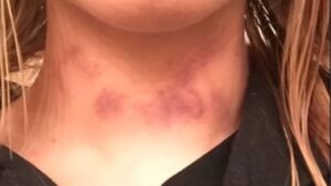 PHOTO Matt Araiza's Victim Looked Like She Had Bite Marks All Over Her Neck After The Attack