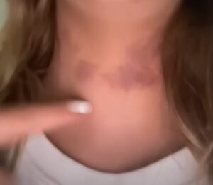 PHOTO Of Bruises Matt Araiza's Victim Had On Her Neck After Being Raped By Him And His Friends