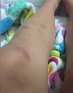 PHOTO Of Massive Painful Bruises Matt Araiza's Victim Had On Her Legs From Incident
