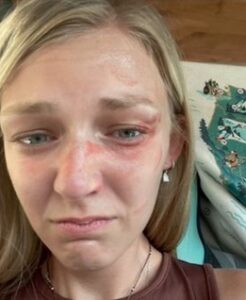 PHOTO Gabbie Petito's Face All Red And Swollen From Brian Potentally Smacking Her In The Face