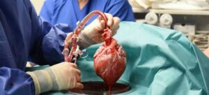 PHOTO Man Who Received Pig Heart Transplant Had His Own Body And Immune System Attack It After The Procedure Was Complete