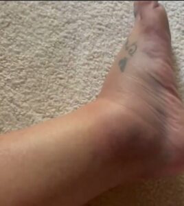 PHOTO Close Up Of Britney Spears' Swollen Ankle After Twisting It During Fight