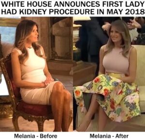 PHOTO White House Announces First Lady Had Kidney Procedure In May 2018 Before And After Meme