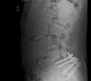 PHOTO Luigi Mangione's Back X-Ray Showing 4 Screws Drilled Into His Spine