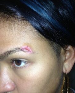 PHOTO Of Cassie Ventura's Injuries Caused By P Diddy