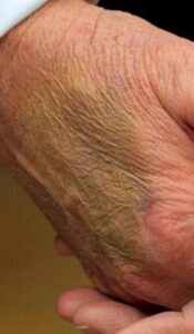 PHOTO Donald Trump's Hand Turned Green From His Medical Condition