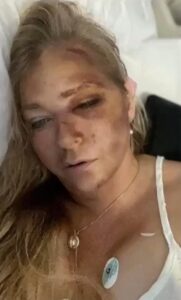 PHOTO What Virginia Giuffre Looked Like After Bus Crash