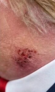 PHOTO Donald Trump Has A Nasty Red Rash On His Neck